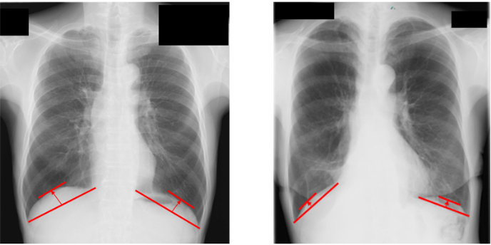A simple X-ray measure linked to survival in lung cancer surgery patients