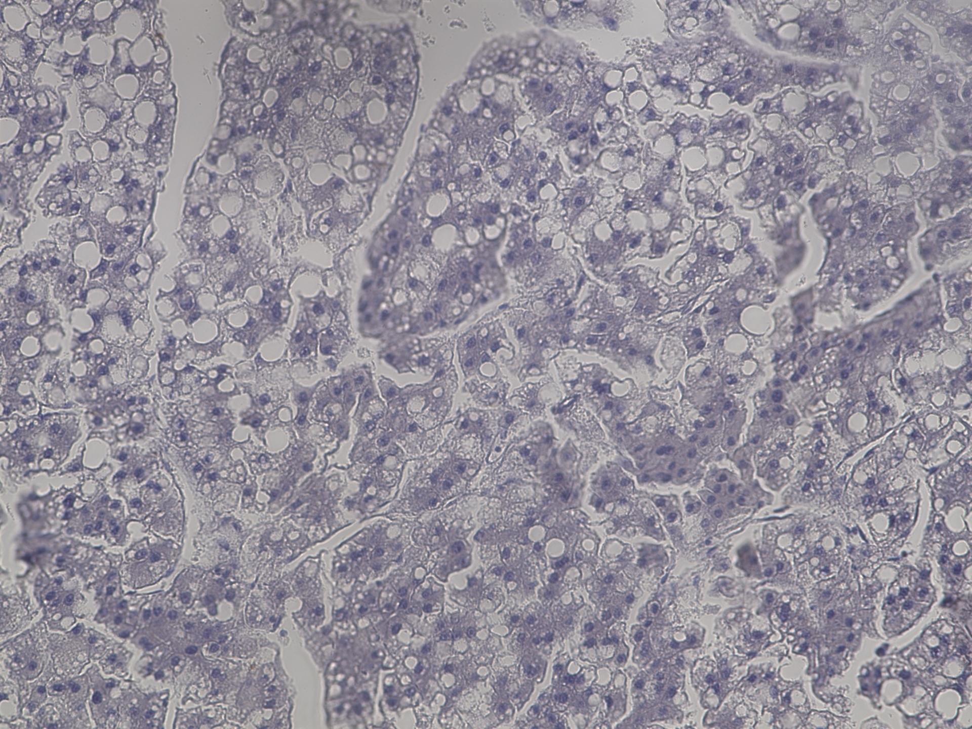 Verified the Efficacy and Safety of Immune Checkpoint Inhibitor "Opdivo" in Advanced Hepatocellular Carcinoma Patients with Poor Liver Function - Kindai University