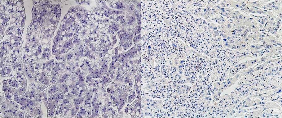 Predicting the effectiveness of Immune Checkpoint Inhibitor. Expected to establish a personalized medical therapy for liver cancer -- Kindai University