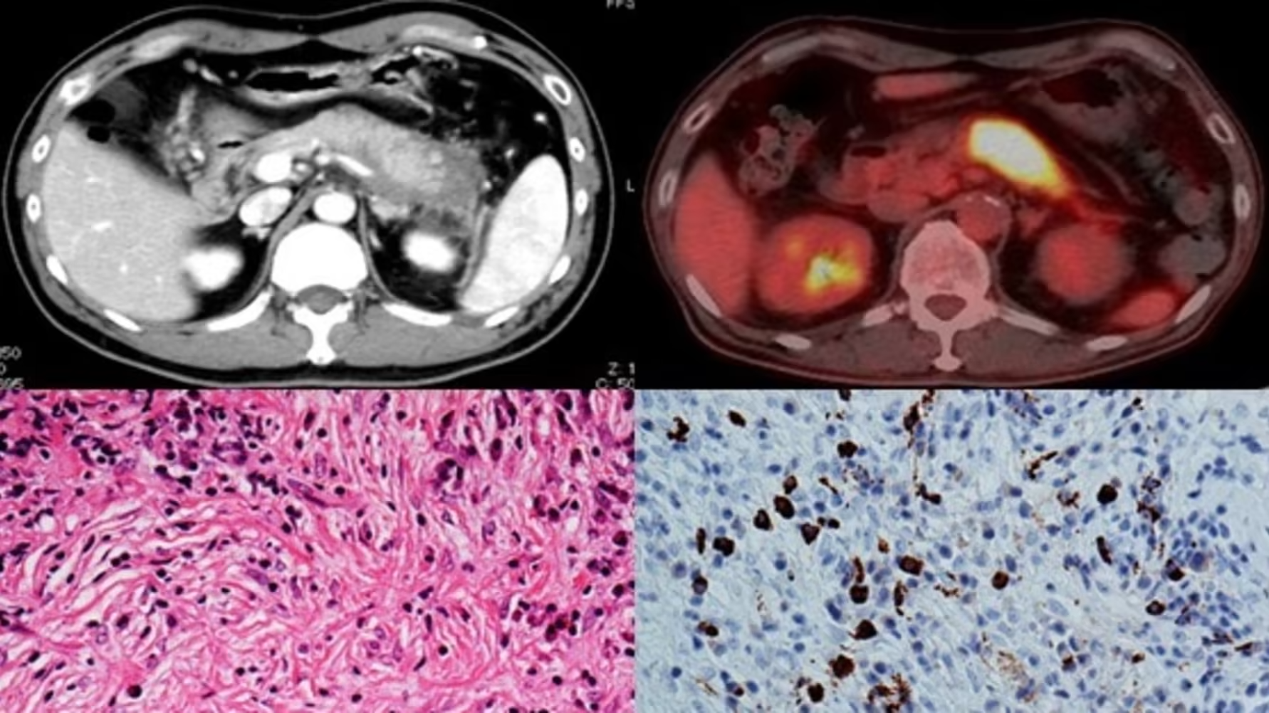 World's first! Identified pathogenic bacteria for autoimmune pancreatitis: A healthy intestinal environment may help prevent and treat autoimmune pancreatitis -- Kindai University