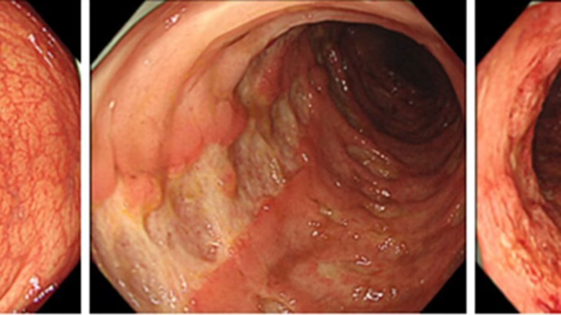 Elucidation of pathogenesis of ulcerative colitis and Crohn's disease: Leading to new treatment methods for refractory inflammatory bowel diseases -- Kindai University