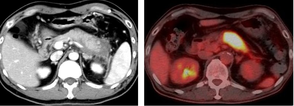 Treating Autoimmune Pancreatitis Without Steroids: Researchers Develop Novel Approach