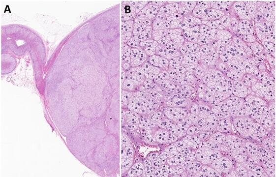 Elucidating the Mechanism of Aldosterone Overproduction by Adenomas Presents Novel Hypertension Drug Target -- Kindai University