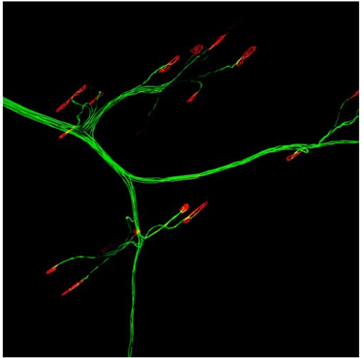 Elucidating the link between Guillain-Barré syndrome and Takotsubo cardiomyopathy -- Kindai University