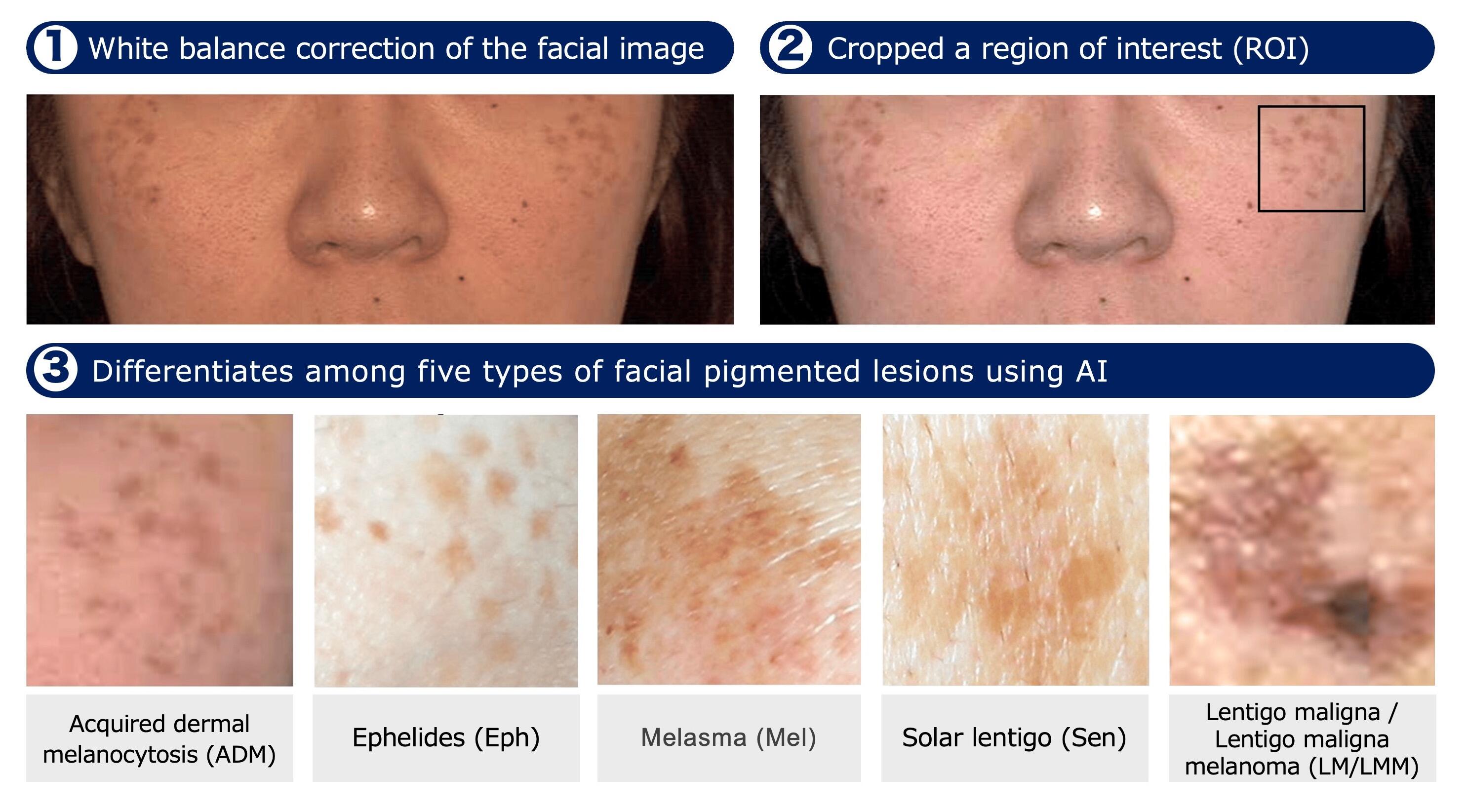 Developed an AI-based classification system for facial pigmented lesions