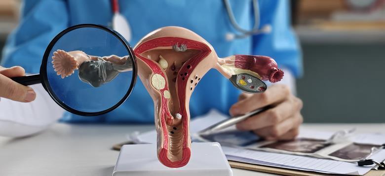 IL-17 identified as potential immunotherapy biomarker in ovarian cancer｜Drug Target Review