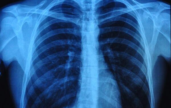 Simple Chest X-Ray Measure Predicts Survival After Lung Cancer Surgery｜MedImaging