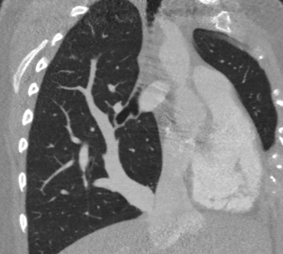 First "Double-decker" surgery for scimitar syndrome | Healthcare in Europe