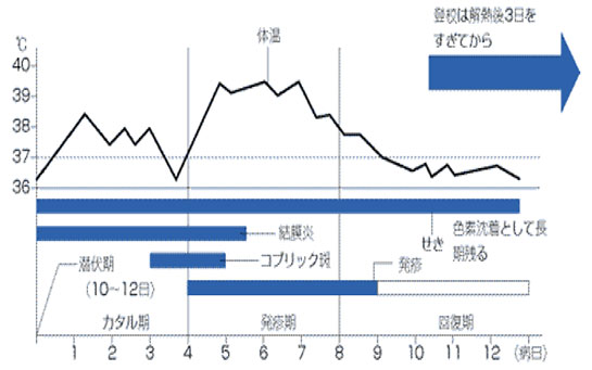 麻しんの臨床経過