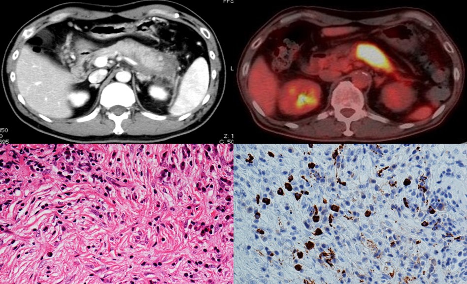 世界初！指定難病 自己免疫性膵炎の病原性細菌を同定　健全な腸内環境が自己免疫性膵炎の予防と治療に役立つことを示唆