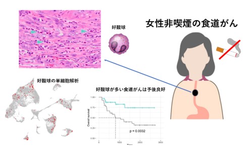 女性非喫煙者の食道がん発症に免疫が関与　－好酸球が多いがんは予後良好－