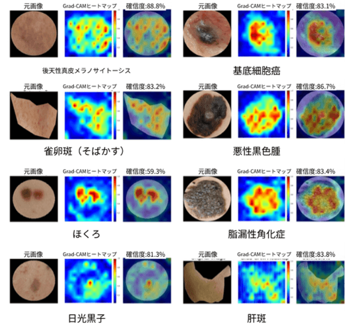 8種類の色素性皮膚病変を高精度で判別　診断根拠を可視化するAIを開発、医療現場への導入に期待