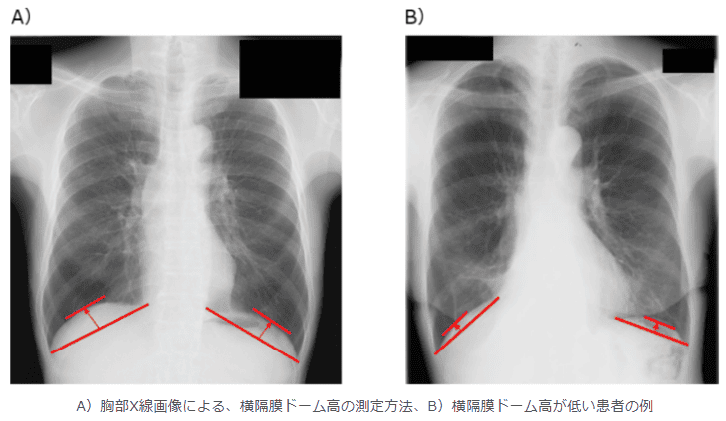 肺がん患者の手術前の横隔膜の位置と予後の関連性を検証　手術のリスク評価や治療戦略立案への貢献が期待される研究成果