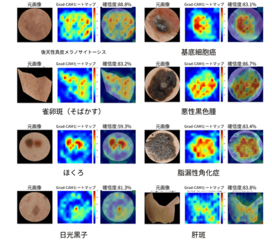 8種類の色素性皮膚病変を高精度で判別　診断根拠を可視化するAIを開発、医療現場への導入に期待